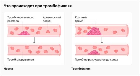 Почему тромбы оторвались: основные факторы риска