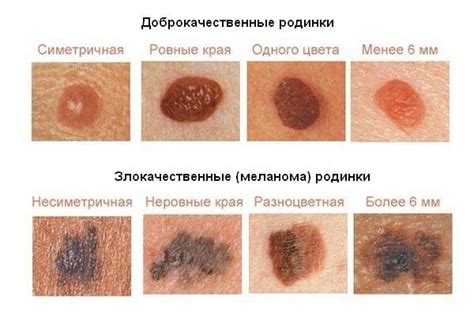 Появление родинок в двойном исполнении