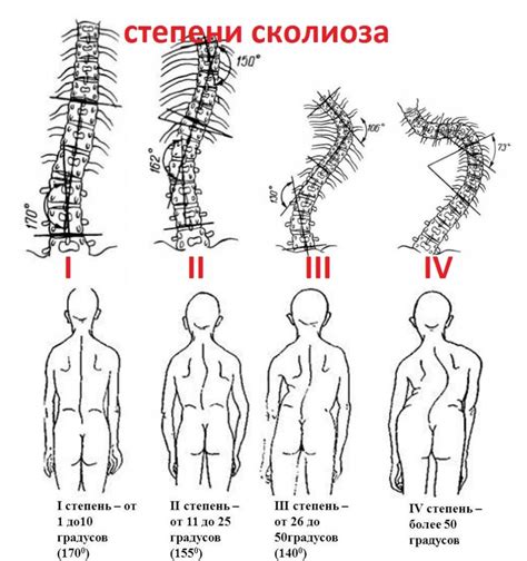 Правосторонний сколиоз: что это такое