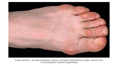 Предупреждение возникновения болей в больших пальцах на ногах