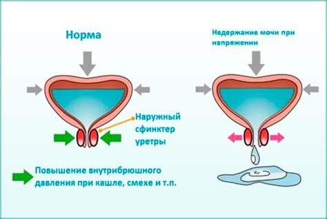 Преимущества воды при недержании мочи