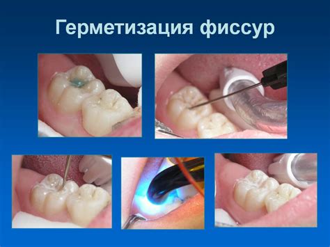 Преимущества герметизации фиссур в зрелом возрасте