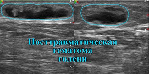 Преимущества исследования узи мягких тканей