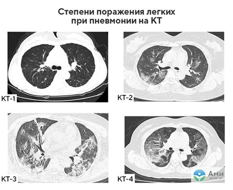 Преимущества компьютерной томографии легких