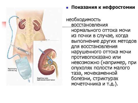 Преимущества нефростомии