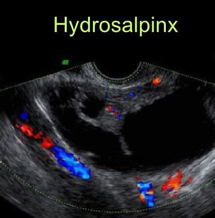 Признаки гидросальпинкса слева на УЗИ
