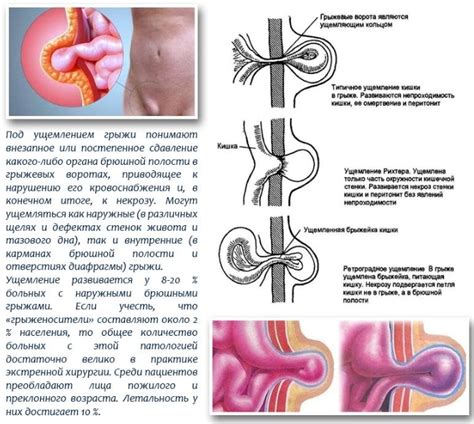 Признаки грыжи у младенцев