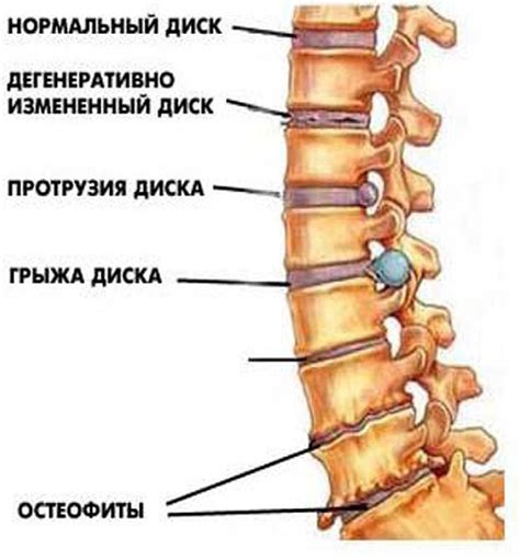 Признаки дегенеративно-дистрофических изменений поясничного отдела позвоночника