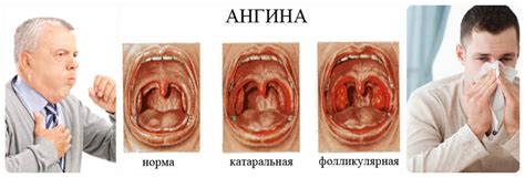 Признаки и симптомы ангины