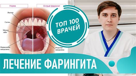 Признаки острого фарингита