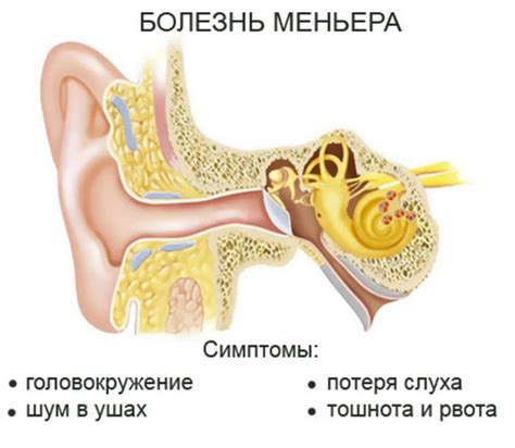 Признаки слабого вестибулярного аппарата