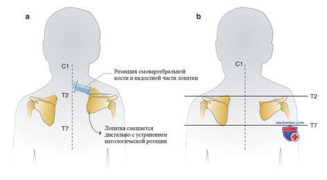 Причины асимметрии лопаток у детей