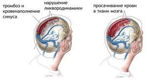 Причины асимметрии поперечных синусов головного мозга