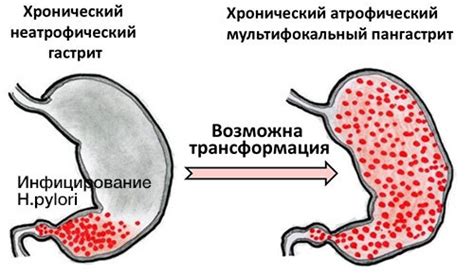 Причины атрофического антрум гастрита