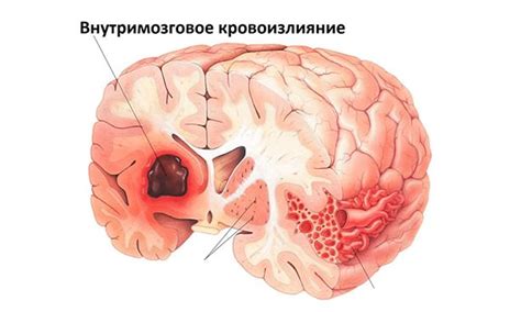 Причины внутримозгового кровоизлияния