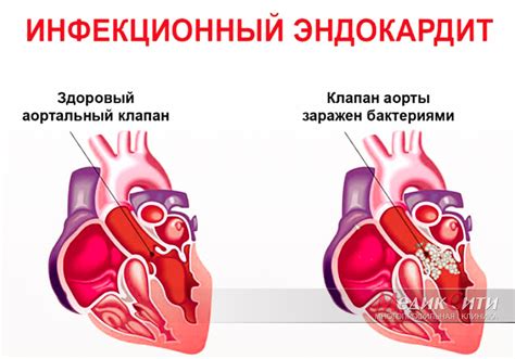 Причины возникновения вегетации эндокардита