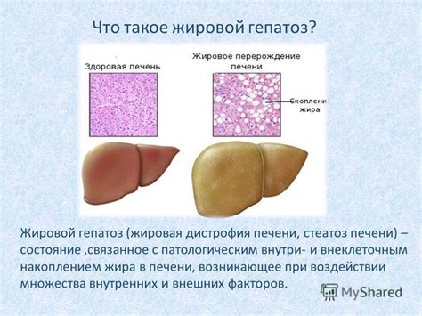 Причины возникновения гепатомегалии жирового гепатоза