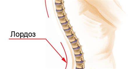 Причины возникновения лордоза
