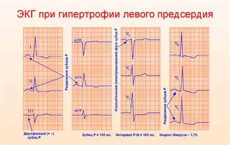 Причины возникновения нарушений левого предсердия на ЭКГ: важные факторы