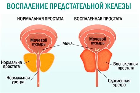 Причины возникновения неоднородной структуры предстательной железы