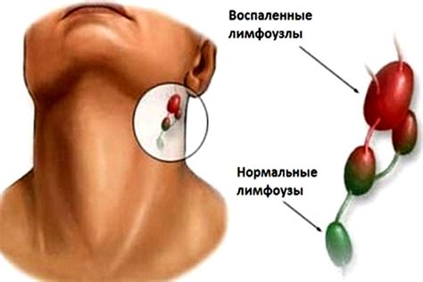 Причины возникновения неспецифических лимфоузлов