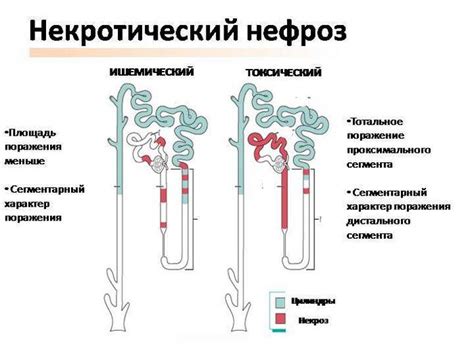 Причины возникновения нефроза 1 степени