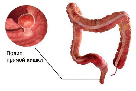 Причины возникновения полипов