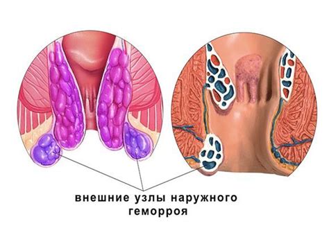 Причины возникновения рецидива кисты