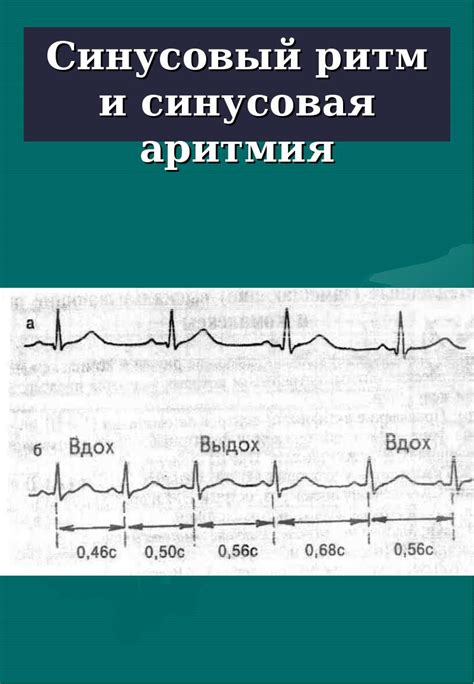 Причины возникновения синусового ритма с неполной блокадой ПНПГ