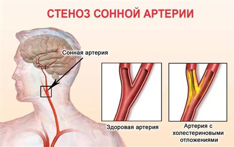 Причины возникновения стеноза