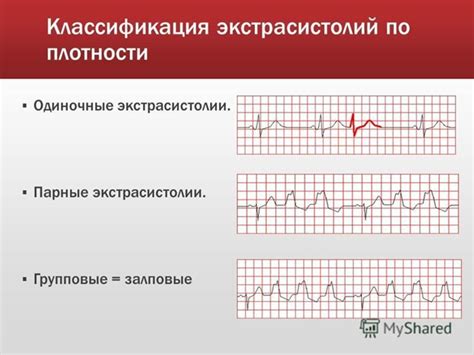 Причины возникновения экстрасистолии ЖЭС