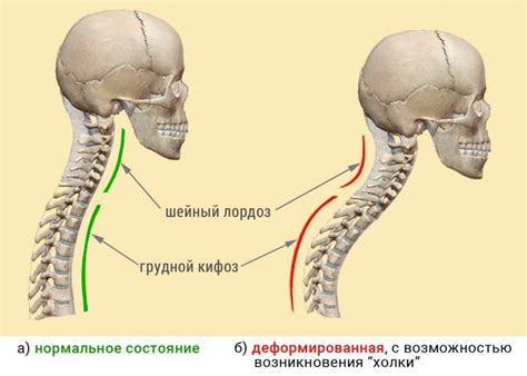 Причины выпрямления шейного лордоза