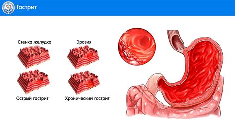 Причины гастрита второй степени