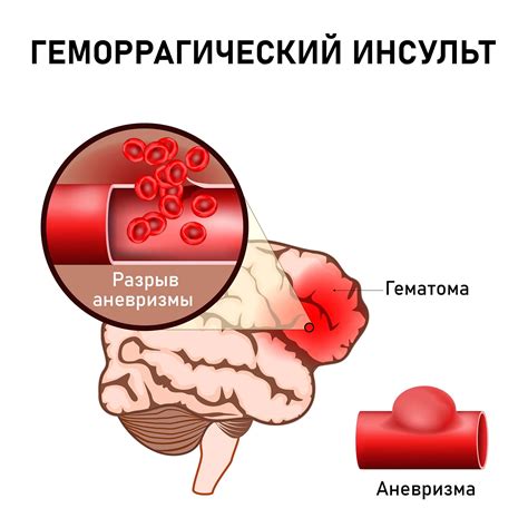 Причины геморрологического инсульта