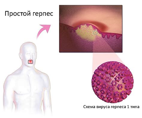 Причины герпеса