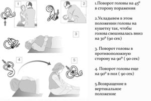 Причины головокружения при ложении и способы лечения