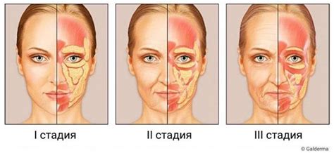 Причины гравитационного птоза лица