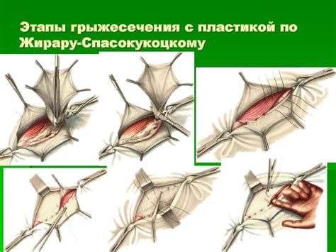 Причины грыжесечения