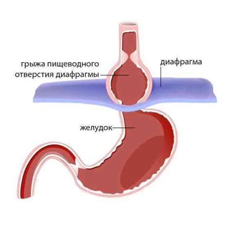 Причины грыжи диафрагмы пищевода