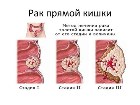 Причины гула в прямой кишке: что это может означать