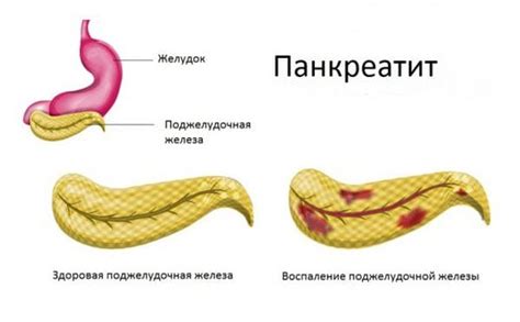 Причины изменения размера хвоста поджелудочной железы