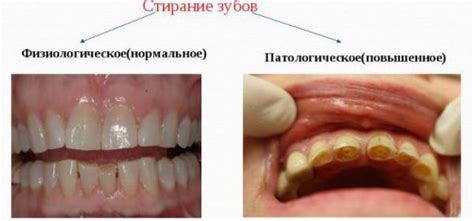 Причины и возможные проблемы стука зубов