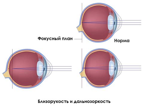 Причины и лечение затуманенного зрения глаз