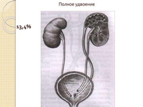 Причины и последствия расширения мочеточников