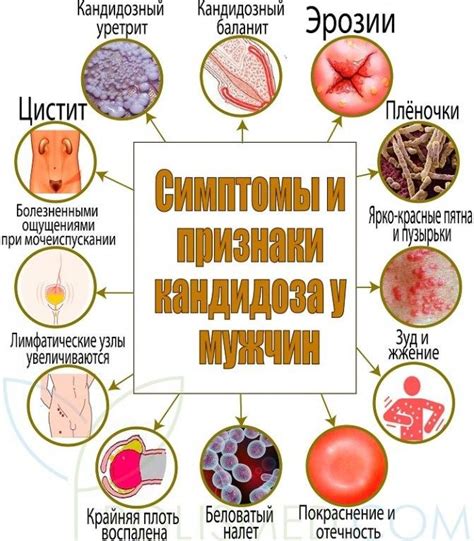 Причины и симптомы молочницы