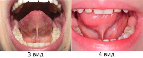 Причины и симптомы уздечки языка у ребенка