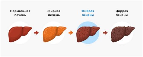 Причины и стадии цирроза печени