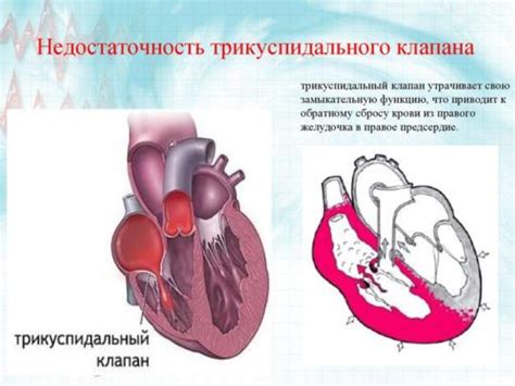 Причины и факторы возникновения уплотнения трикуспидального клапана