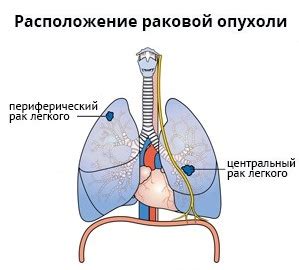 Причины коллапса левого легкого