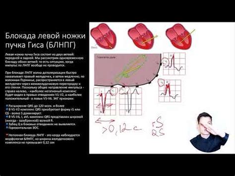 Причины локальной внутрижелудочковой блокады